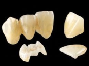 Ceramic Teeth